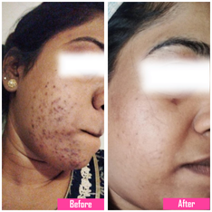 acne treatment image
