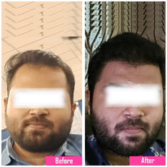 hair transplant image