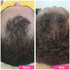 prp treatment image