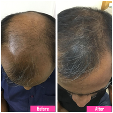 prp treatment image
