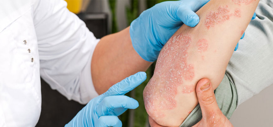Psoriasis Treatment Chennai