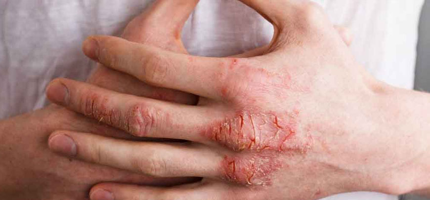 Eczema Treatment Chennai