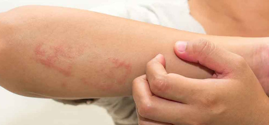 Scabies Treatment Chennai