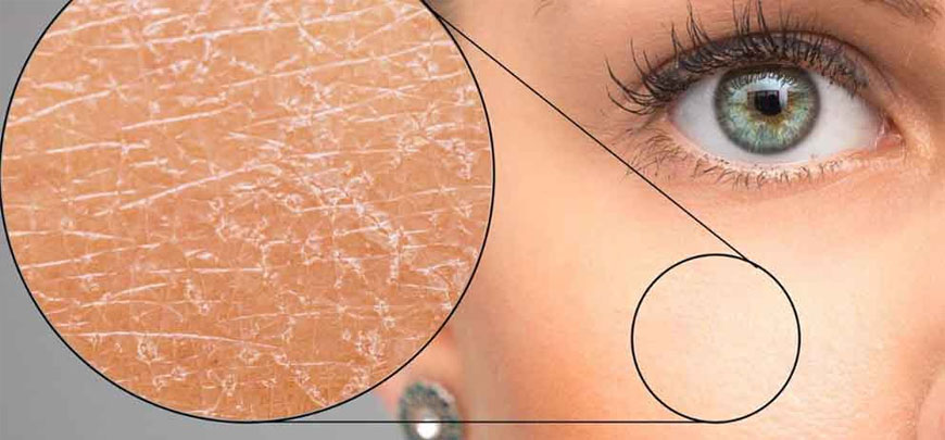 Dry Skin – Xeroderma Treatment Chennai
