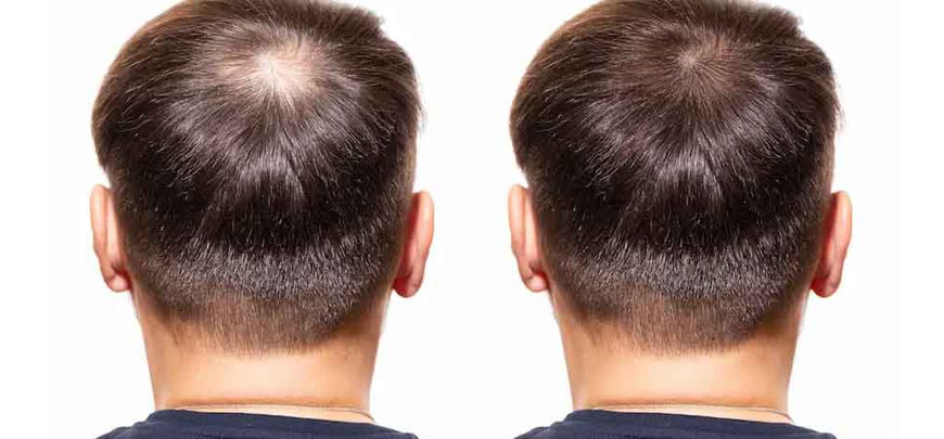 Hair Loss Treatment Chennai