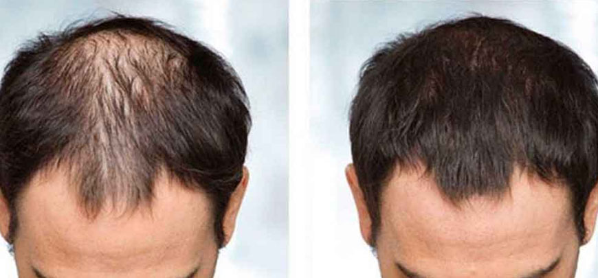 Male Pattern Baldness Treatment Chennai