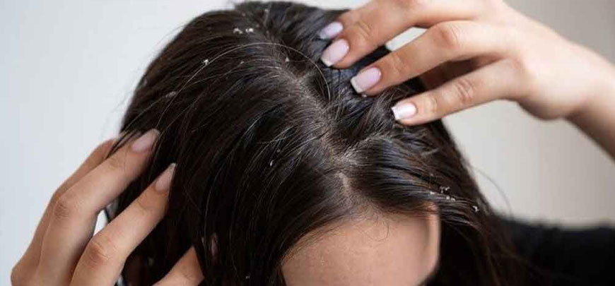 Hair Dandruff Treatment Chennai