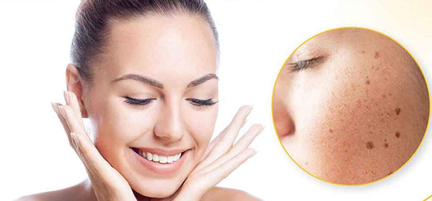 Skin Pigmentation Treatment Chennai
