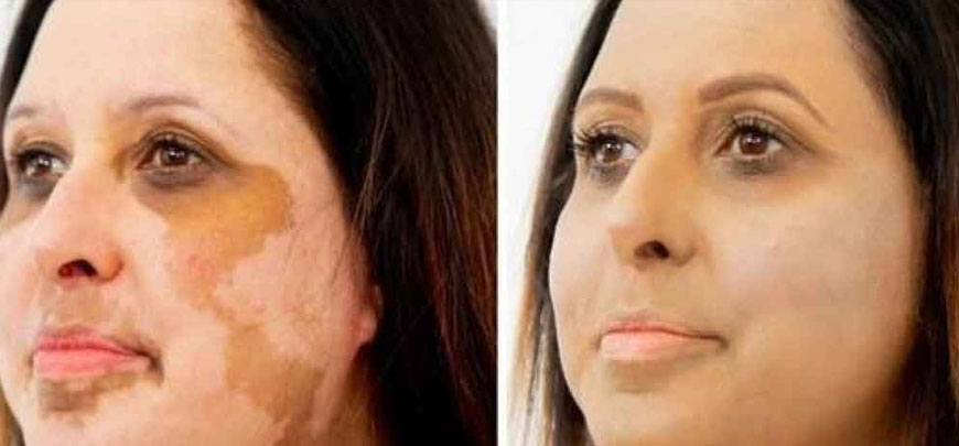 Vitiligo Treatment in Chennai