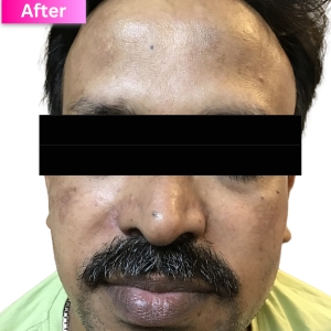 PRP treatment After Image