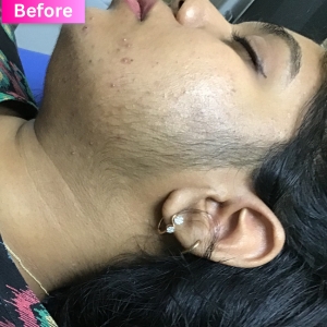 Laser Hair Removal Treatment Before Image