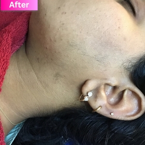 Laser Hair Removal Treatment After Image