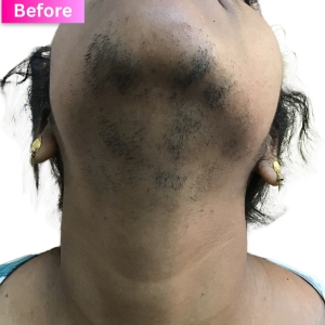 Laser Hair Removal Treatment Before Image