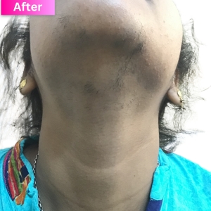 Laser Hair Removal Treatment After Image