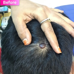 Wart/Mole Removal Treatment Before Image