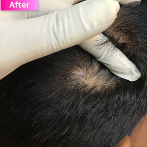Wart/Mole Removal Treatment After Image