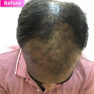 PRP treatment Before Image