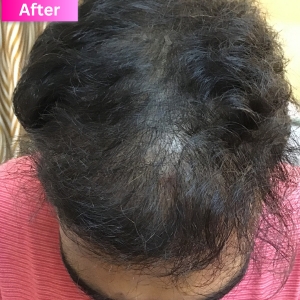 PRP treatment After Image