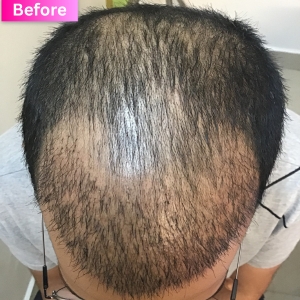PRP treatment Before Image