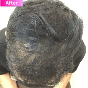 PRP treatment After Image