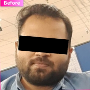 Hair Transplant Treatment Before Image