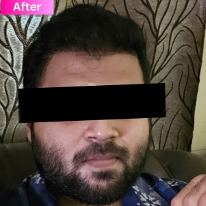 Hair Transplant Treatment After Image