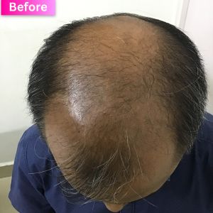 Hair Thinning Treatment Before Image