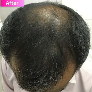 Hair Thinning Treatment After Image