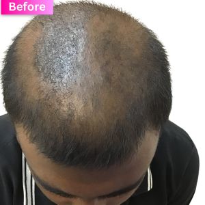Hair Thinning Treatment Before Image