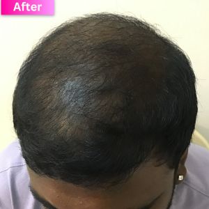 Hair Thinning Treatment After Image