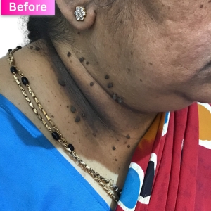 Wart/Mole Removal Treatment Before Image
