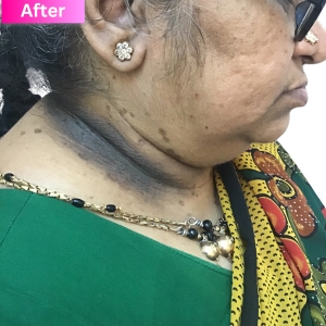 Wart/Mole Removal Treatment After Image
