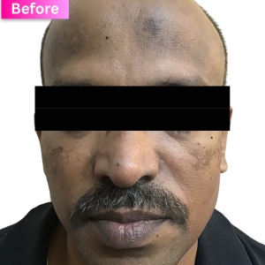 PRP treatment Before Image
