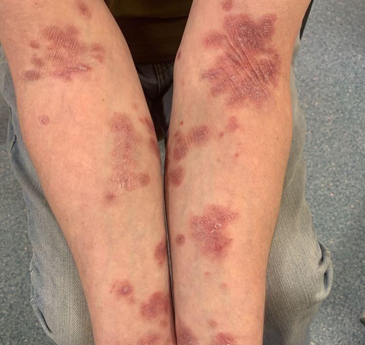 Laser Tattoo Removal