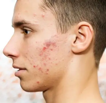 Acne / Pimples Treatment