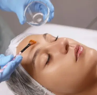 Chemical Peel Treatment