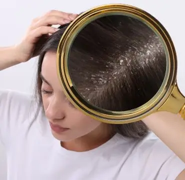 Dandruff Treatment