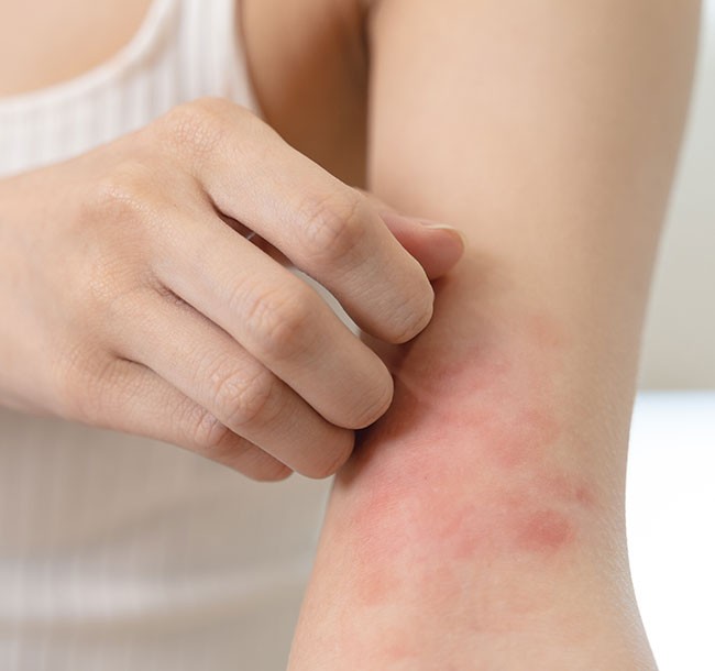 Treatment of Eczema & Dermatitis in Chennai