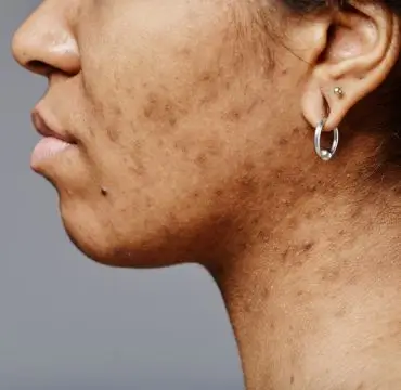 Skin Pigmentation