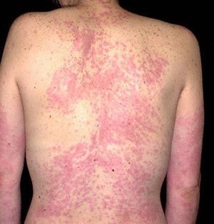 Chronic Urticaria (Hives) Treatment in Chennai