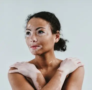 Vitiligo Treatment